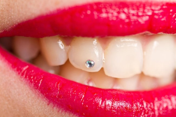 Дентальна інкрустація. Як привернути увагу до усмішки?